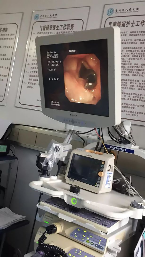 【重口味】超恐怖!喉咙咳出血 检查后惊觉是3公分长的这个物种