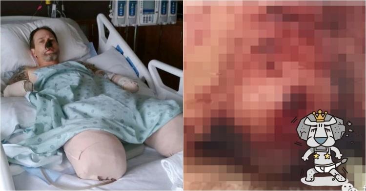 舔一舔就讓你斷手斷腳!男子被狗舔不到20天就死亡 可怕的是這非個案...:要很小心啊