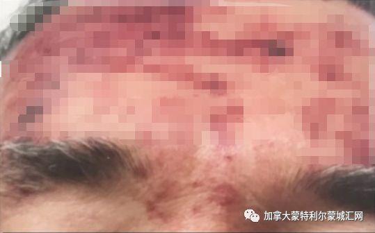 舔一舔就讓你斷手斷腳!男子被狗舔不到20天就死亡 可怕的是這非個案...:要很小心啊