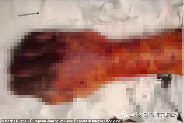 舔一舔就讓你斷手斷腳!男子被狗舔不到20天就死亡 可怕的是這非個案...:要很小心啊