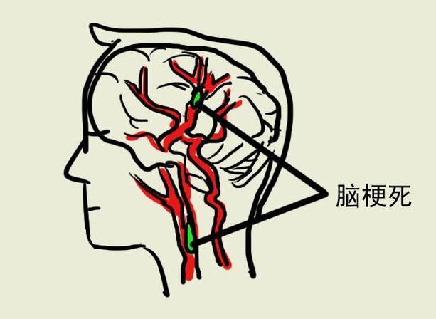 醫生提醒：睡覺時有這種表現就是「中風前兆」！