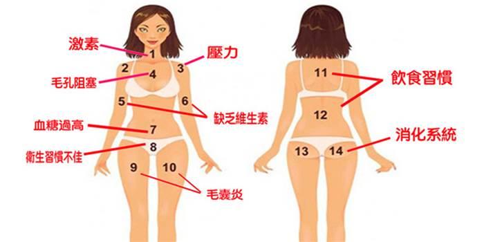 身體這部位長痘,竟與「內分泌」、「血糖」有關?秒懂【痘痘位置圖】,從此對癥下藥,永絕後患!