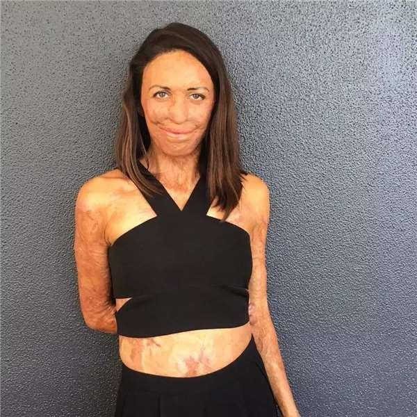 热爱马拉松的她惨遭火吻,面临烫伤,毁容,截肢…在挚爱