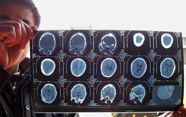 大腦血管好不好，「抬雙臂」可能會知道，不論男女，不妨自測一下